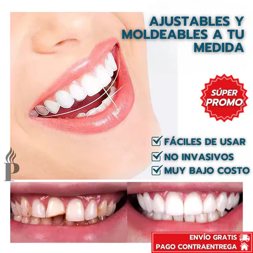 CARILLAS DENTALES AJUSTABLES - SNAP-ON SMILE😀